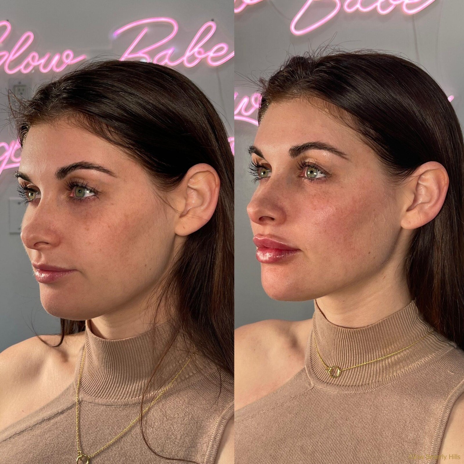 Facial Balancing Before and After