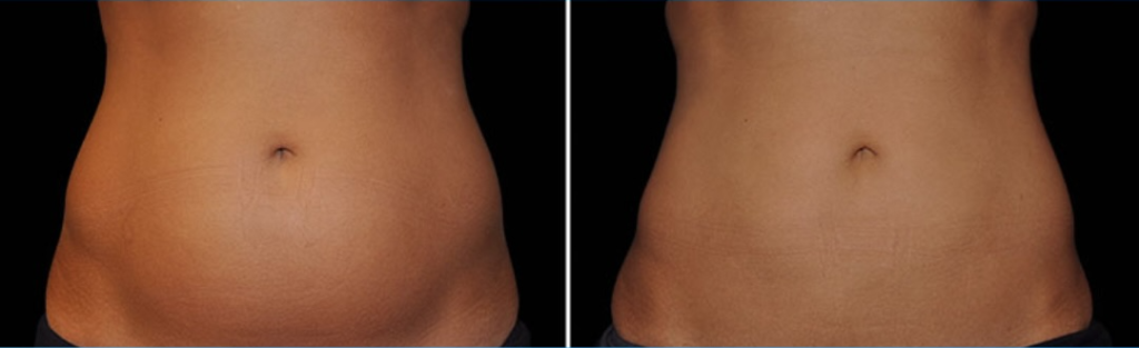 CoolSculpting Stomach Skin Tightening Procedures in Beverly Hills