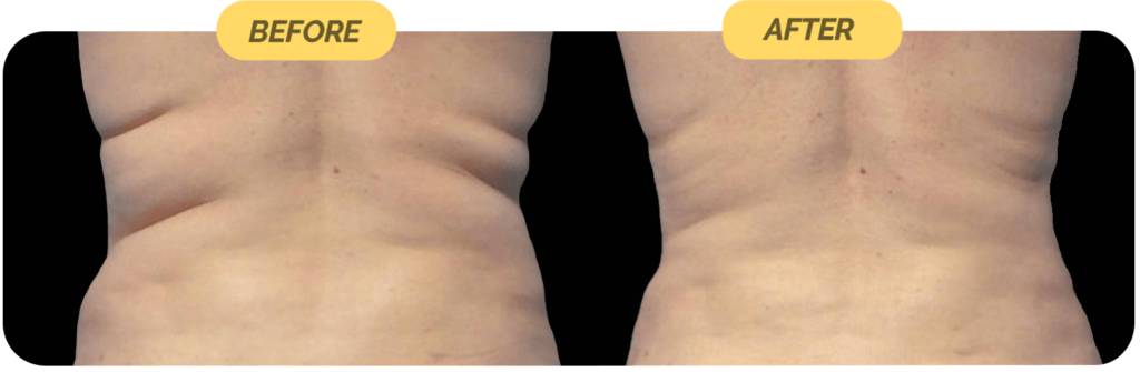 coolsculpting-before-after-10-optimized-1024x335