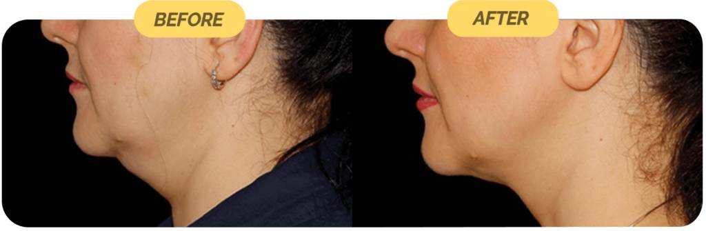 coolsculpting-before-after-11-optimized-1024x335