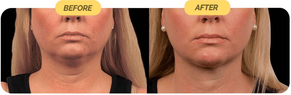 coolsculpting-before-after-12-optimized-1024x335