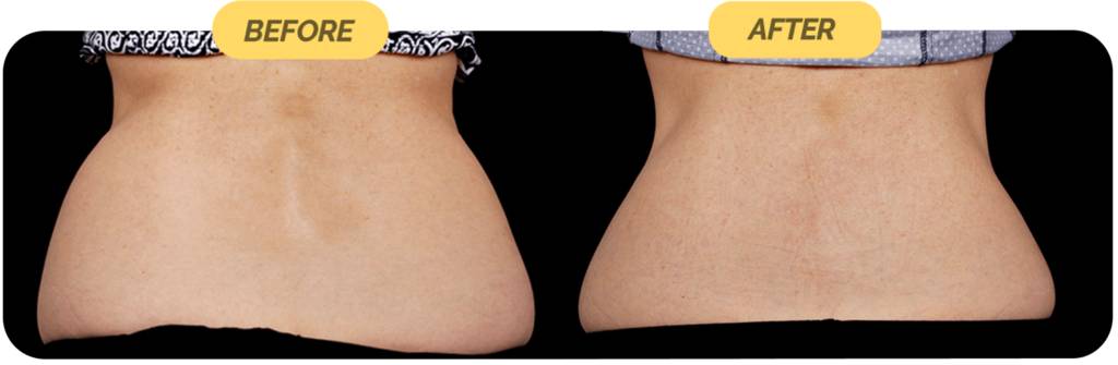 coolsculpting-before-after-2-optimized-1024x335