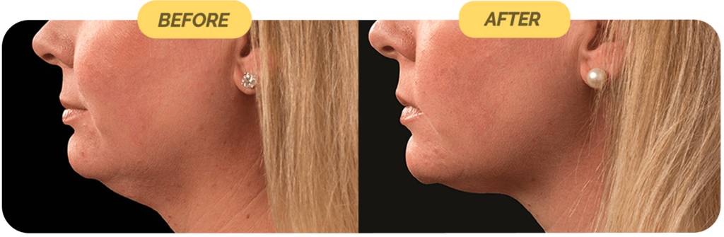 coolsculpting-before-after-3-optimized-1024x335