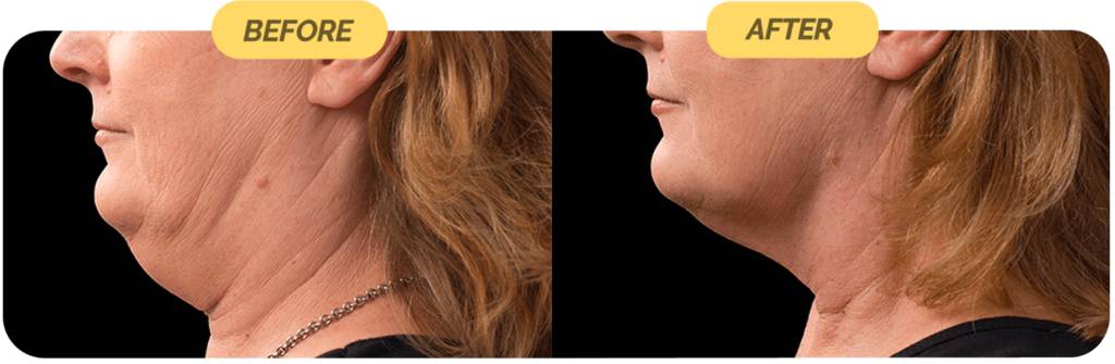 coolsculpting-before-after-4-optimized-1024x335