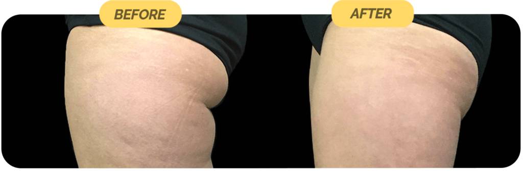 coolsculpting-before-after-5-optimized-1024x335