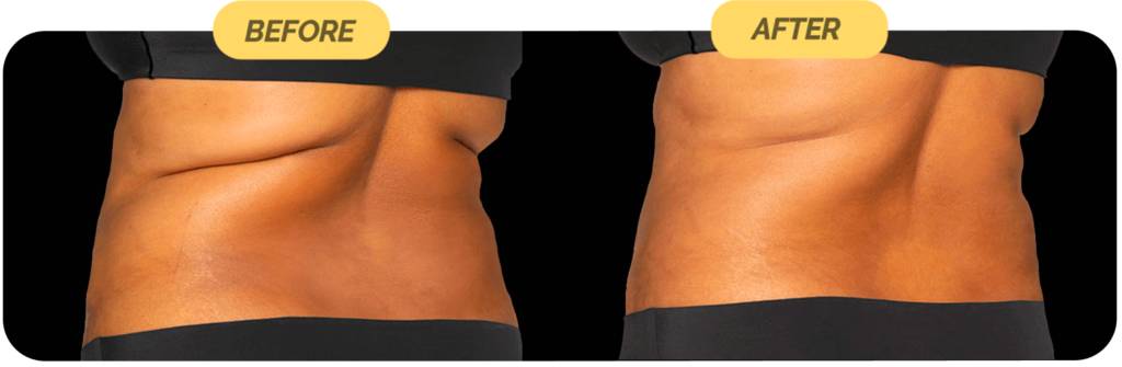 coolsculpting-before-after-6-optimized-1024x335