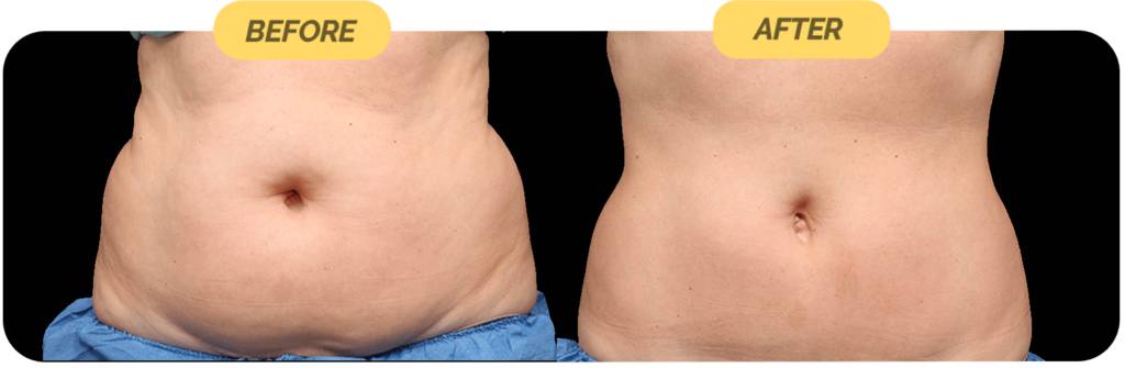 coolsculpting-before-after-7-optimized-1024x335