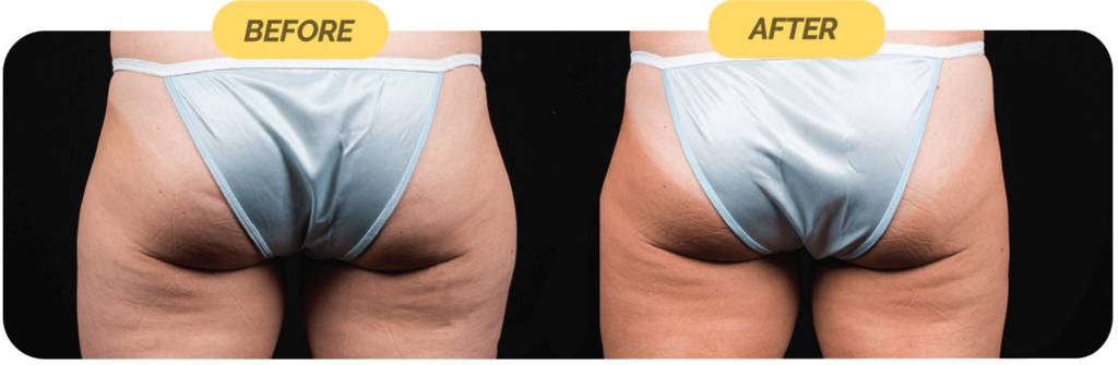 coolsculpting-before-after-9-optimized-1024x335