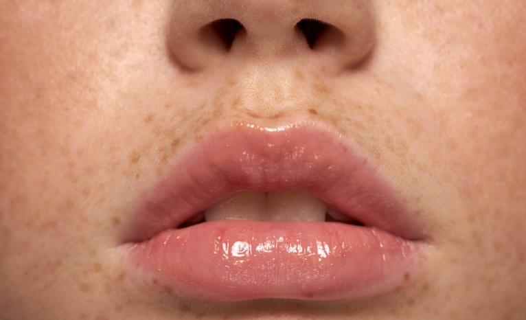 Read more about the article The Science Behind Perfect Lips: Lip Fillers in Beverly Hills