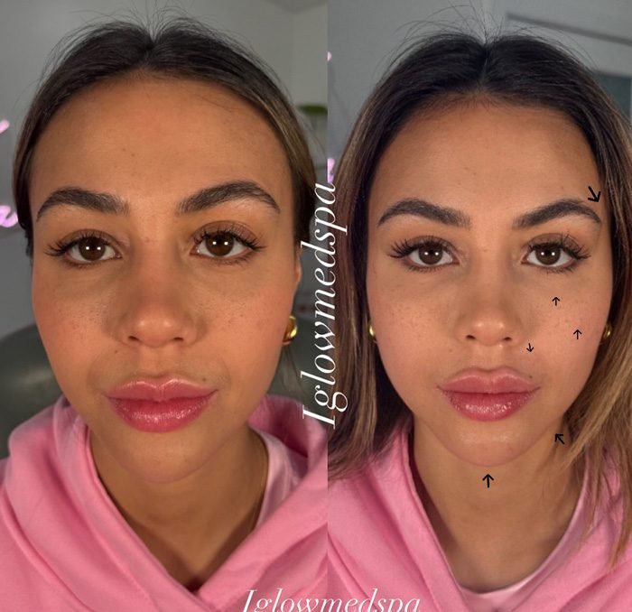 Facial Balancing Before and After