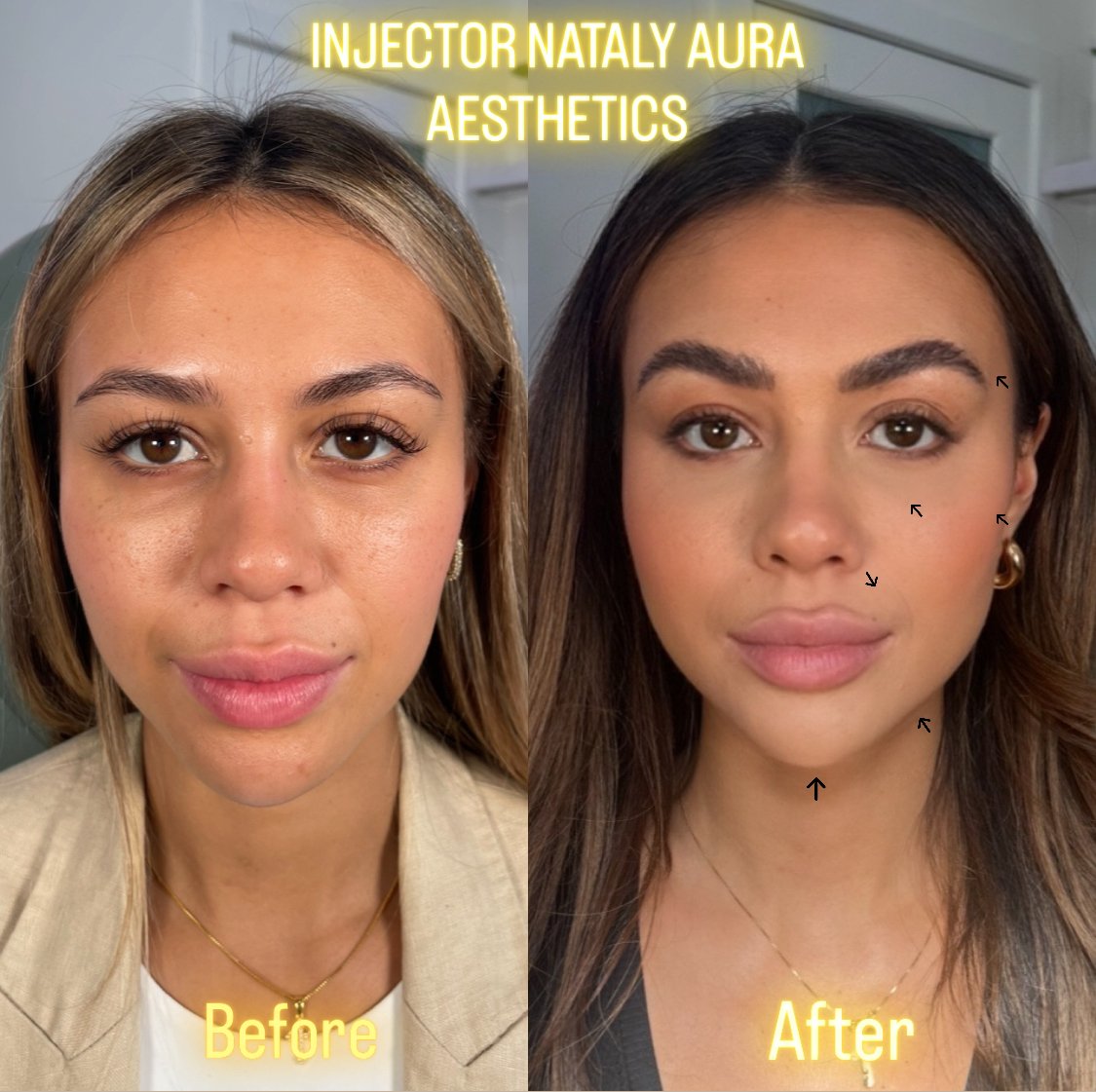 Facial Balancing Before and After